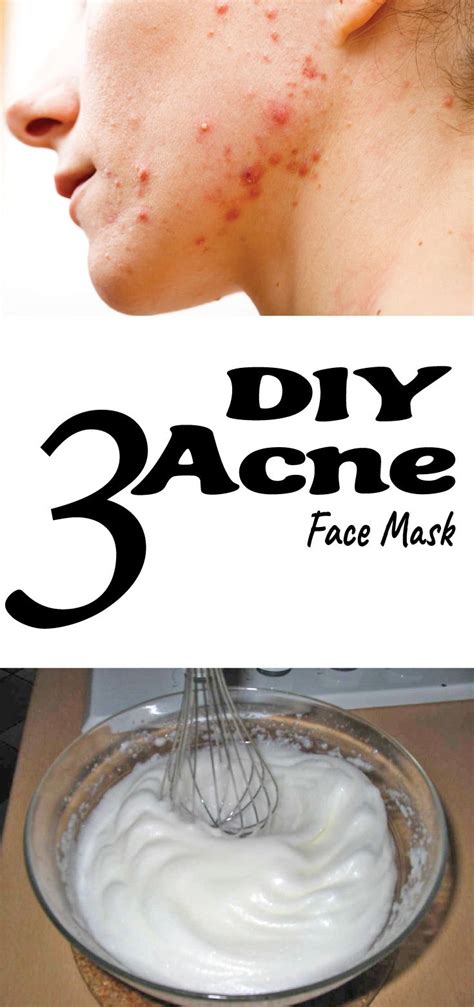 Face masks can be expensive, but the experience of putting something on your face that will apple cider vinegar is highly acidic and kills bacteria on your face, which helps with acne. 3 DIY Acne Face Mask | Face mask diy acne, Acne face mask, Face acne