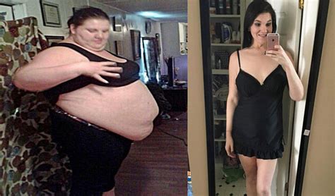 Woman In America Sheds Kg Weight With The Help Of Surgeries द