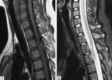 Now whole body contain water at different amt, so projecting wt different contrast. HEMANGIOMA SPINE MRI T1 T2 - Wroc?awski Informator ...