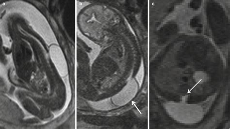 Mri Of Fetal Spine And Extremities Radiology Key