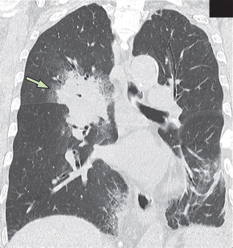 Pulmonary Cryptococcosis Mimicking Lung Cancer The Lancet Infectious