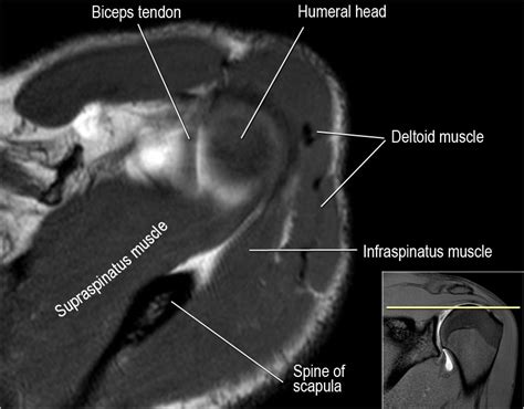 The Radiology Assistant : Shoulder MR - Anatomy