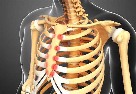 Costochondritis Causes Symptoms Treatment Costochondritis Images And