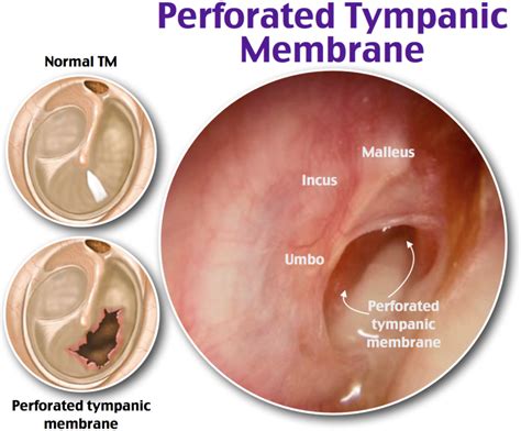 Perforated Tympanic Membrane Medical Surgical Nursing Pediatric