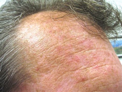 Actinic Keratosis Treatments Plastic Surgery Skin Clinic