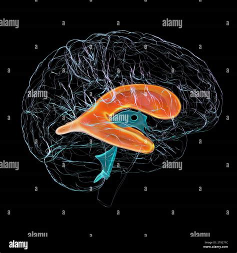 Enlarged Lateral Ventricles Of The Brain Illustration Stock Photo Alamy