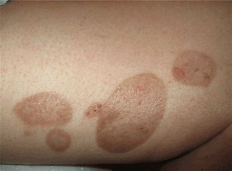 Ringworm On The Legs Of A Patient After Long Term Intensive Care Unit