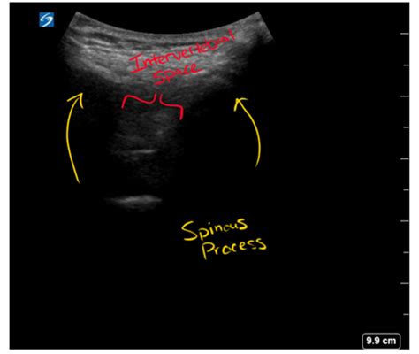 Ultrasound Guided Lumbar Puncture Core Em