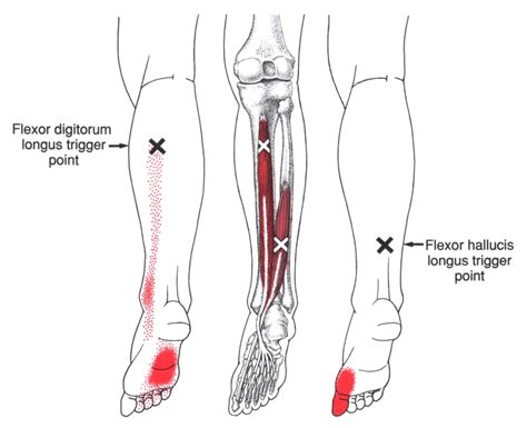Flexor Digitorum Longus The Trigger Point Referred Pain Guide