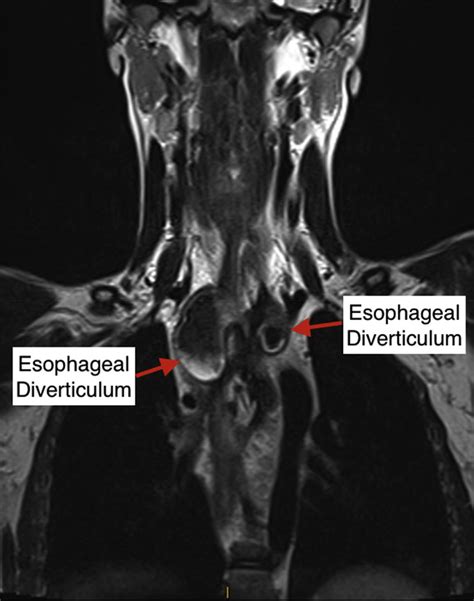 Bilateral Esophageal Diverticula With Mediastinal Inflammatory Changes