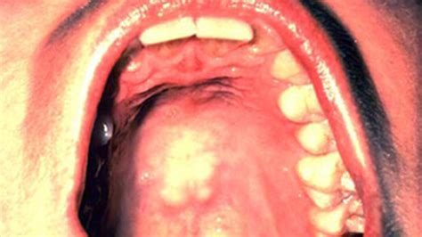 Floor Of Mouth Cancer Causes And Effects Ppt