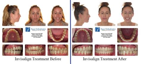 Invisalign For Adults Havertown Haverford Faust Orthodontics