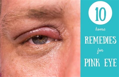 How To Get Rid Of Pink Eye 10 Home Remedies To Treat It Pinkeye