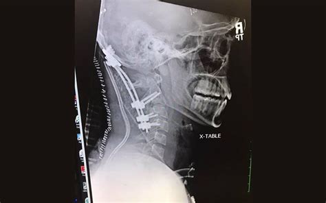 22 Year Old Survives Rare Internal Decapitation Injury From Crash He