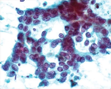 Cytology Smear From Lung Adenocarcinoma Metastatic Into Mediastinal