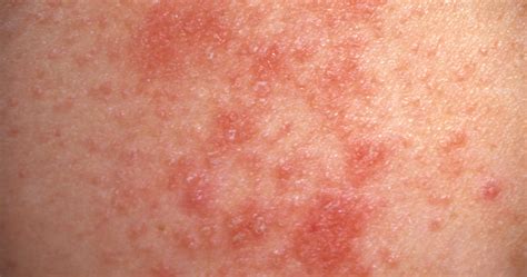 Red And White Spots On Skin Heat Rash Prickly Heat Miliaria