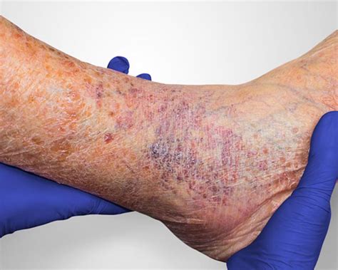 Venous Leg Ulcers What Are The Treatment Options Vein Center In