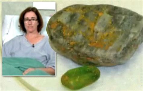 woman who suffered burns after rocks caught fire in her shorts says she thought she had been