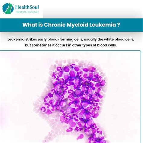 Chronic Myeloid Leukemia Symptoms And Treatment Healthsoul