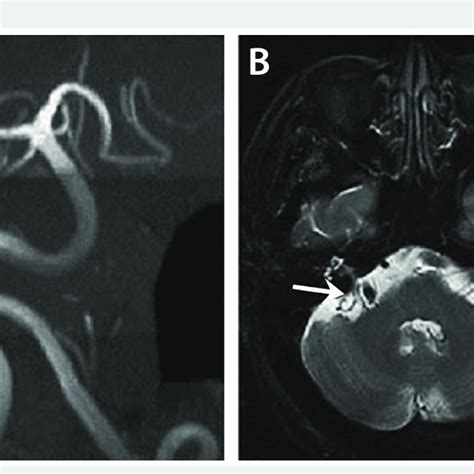 Fabry Disease Axial Diffusion Weighted Mri Sequence Obtained At The