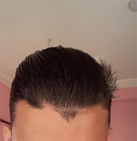 Why I Have This Type Of Hairline Is This Normal Rhair