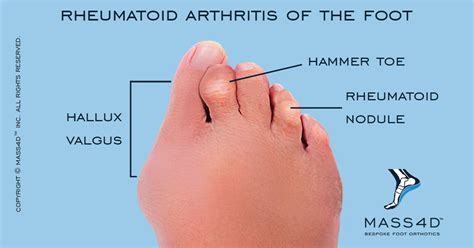 Rheumatoid Arthritis In The Feet Mass4d® Foot Orthotics