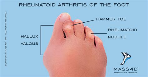 How To Diagnose Rheumatoid Arthritis In Feet