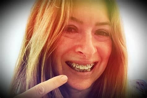Braces For Adults Why One 50 Woman Went Full Metal Mouth Nexttribe