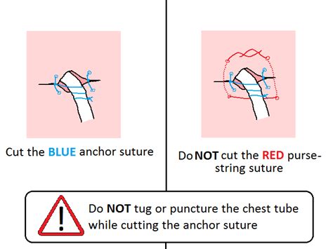 How To Pull A Chest Tube With Pictures Wikihow