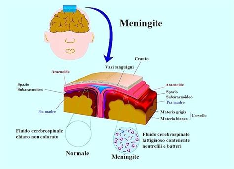 Sintomi Della Meningite Virale E Batterica Nei Bambini Cause E Terapia