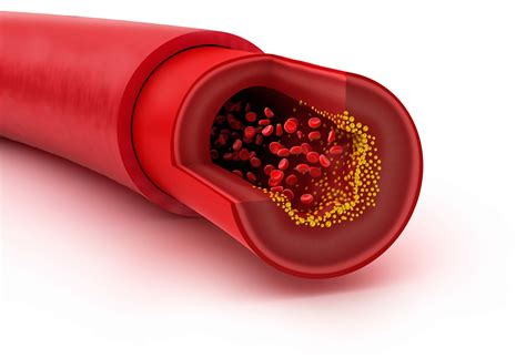 Recent Updates on Cholesterol Treatment - Vascular Health Clinics
