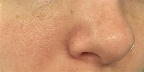 Routine Help How Do I Get Rid Of These Dots On My Face R