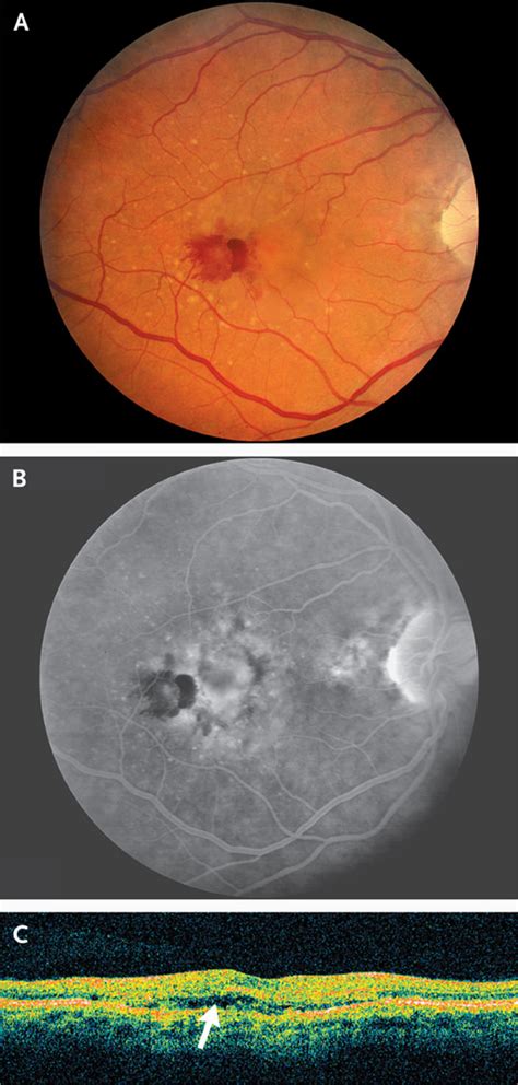 Ranibizumab Therapy For Neovascular Age Related Macular Degeneration Nejm