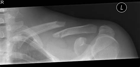 Midshaft Clavicle Fractures Trauma Orthobullets