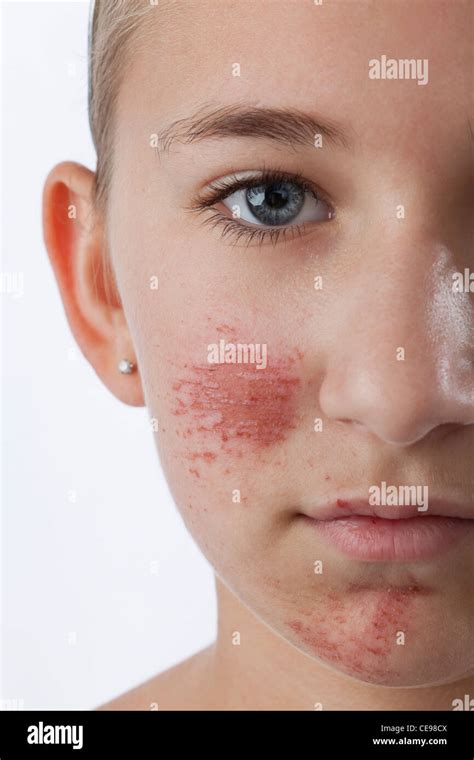 Bruise Child High Resolution Stock Photography And Images Alamy