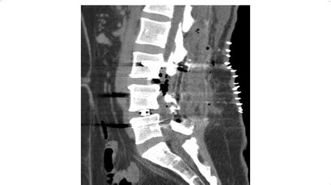 Ct Scan Lumbar Spine Sagital View Download Scientific Diagram