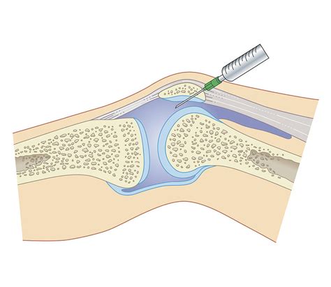 cross section biomedical illustration of removing synovial fluid from knee using joint