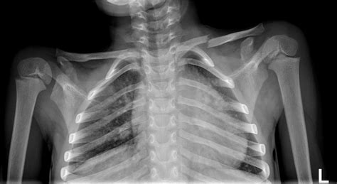 Clavicle Fracture Icd 10 Asking List