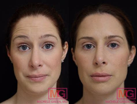 Botox Vs Dysport Difference Between Botox Dysport Injections