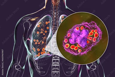 Lung Histoplasmosis A Fungal Infection Caused By Histoplasma