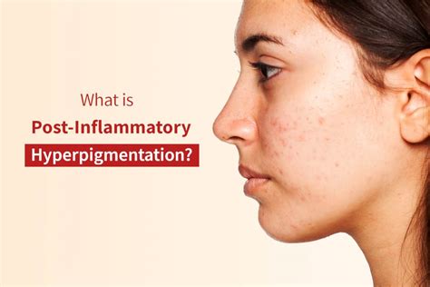 What Is Post Inflammatory Hyperpigmentation