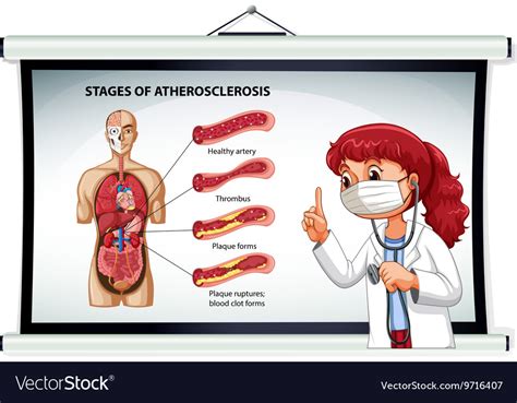 Doctor Explaining Stages Of Atherosclerosis Vector Image