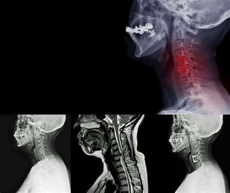 What Is Cervical Spondylosis How To Treat Sitenam