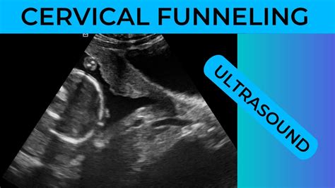 Cervical Funneling On Ultrasound Youtube