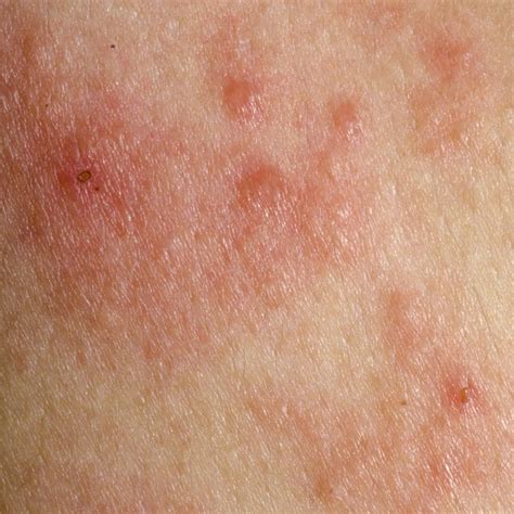 Rash 36 Common Skin Rashes Pictures Causes Treatment