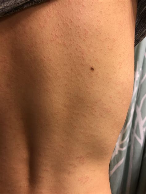 Broke Out In Itchy Rash All Over Back Dermatology