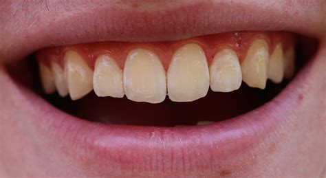 White Spots On Teeth What Can You Do Smile Stories
