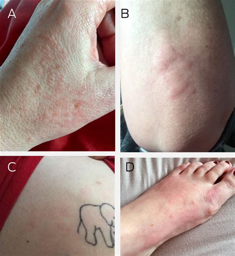 Cutaneous Manifestations Of Covid‐19 Diagnosis And Management The