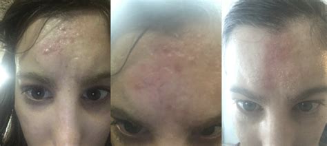 Deep Acne Scars What Are They And Treatment