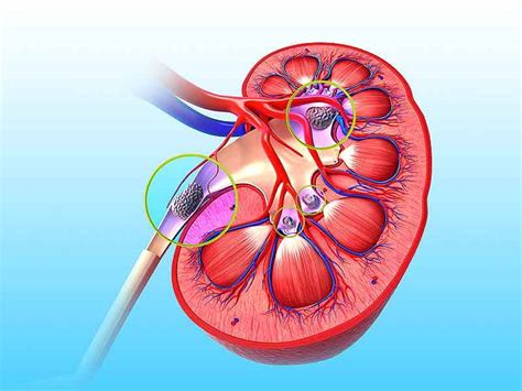 How kidney stones are formed. How To Dissolve Kidney Stones With Parsley At Home - lifealth